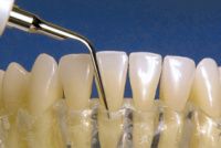 Satelec 10X Interproximal